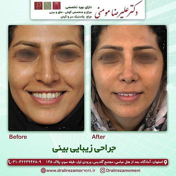 جراحی بینی در اصفهان