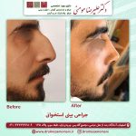 جراحی بینی استخوانی | عمل بینی قوز دار و استخوانی + عکس