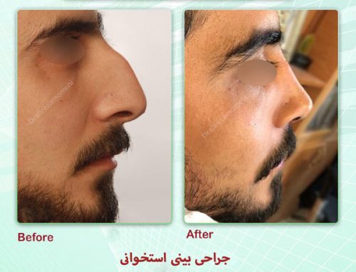 جراحی بینی استخوانی | عمل بینی قوز دار و استخوانی + عکس