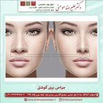 جراحی بینی گوشتی |عمل بینی گوشتی در اصفهان + عکس نمونه کار