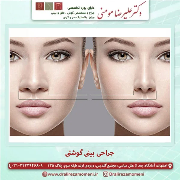 جراحی بینی گوشتی