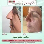 جراحی بینی طبیعی | عمل بینی نچرال و طبیعی در اصفهان + عکس نمونه کار