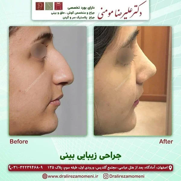 بهترین جراح بینی اصفهان - دکتر علیرضا مومنی