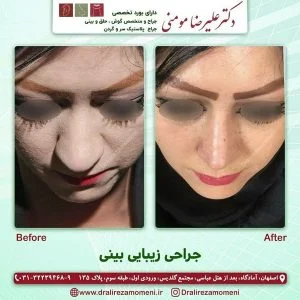 جراحی بینی گوشتی