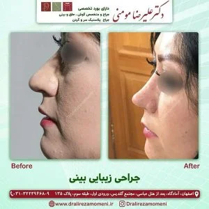 جراحی بینی گوشتی
