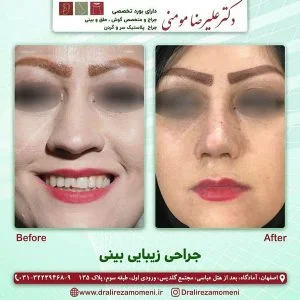 جراحی بینی گوشتی