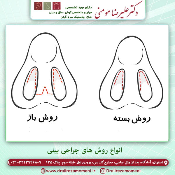انواع روش های جراحی بینی