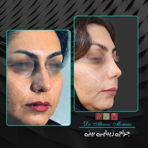 جراحی بینی گوشتی - دکتر علیرضا مومنی