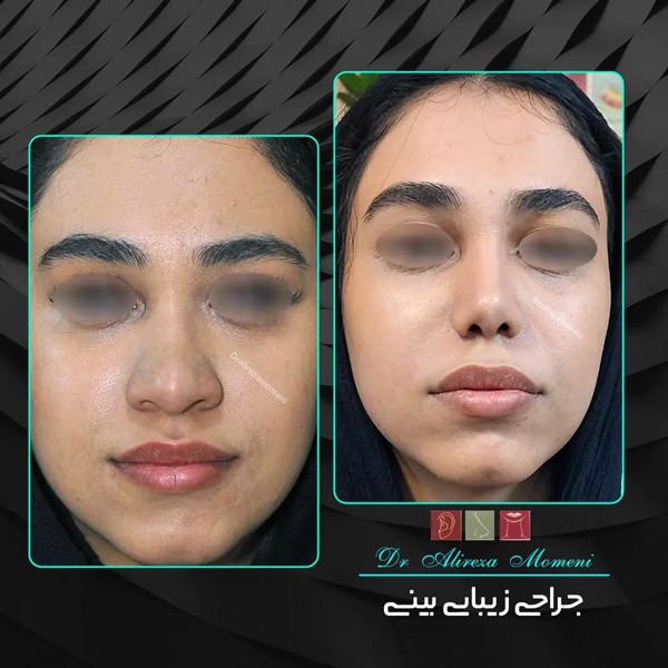 جراحی بینی در اصفهان - دکتر مومنی 