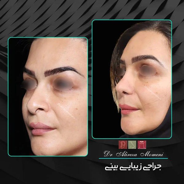 جراحی بینی در اصفهان - دکتر مومنی 