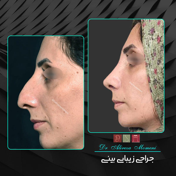 جراحی بینی طبیعی - دکتر مومنی 