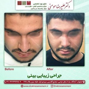 نمونه کار جراح بینی مردانه