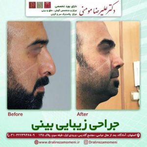 نمونه کار دکتر عمل بینی مردانه