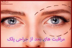 مراقبت های بعد از جراحی پلک - دکتر علیرضا مومنی