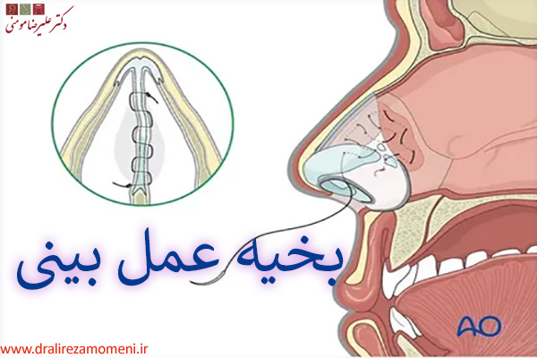 بخیه عمل بینی - دکتر علیرضا مومنی