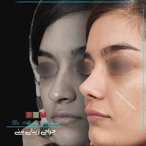 بینی دخترانه