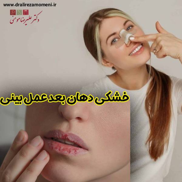 خشکی دهان بعد عمل بینی - دکتر علیرضا مومنی