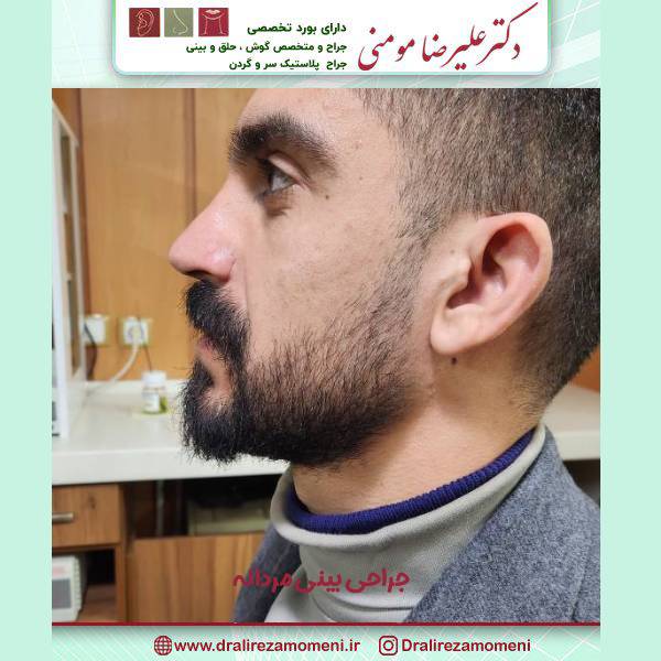 جراحی بینی مردانه 