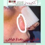 خارش زیر گچ و داخل سوراخ های بینی پس از عمل + نحوه درمان خارش