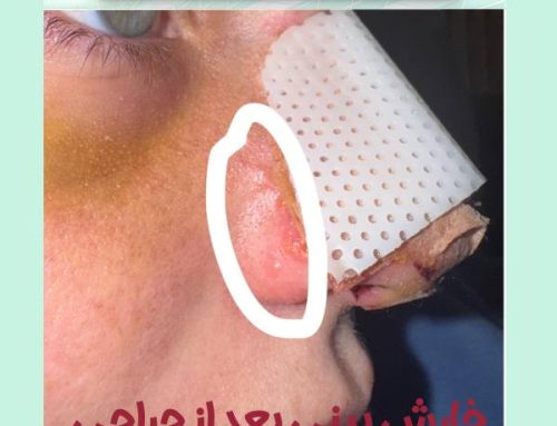 خارش زیر گچ و داخل سوراخ های بینی پس از عمل + نحوه درمان خارش