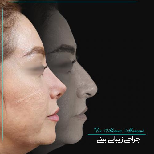 rhinoplasty-454