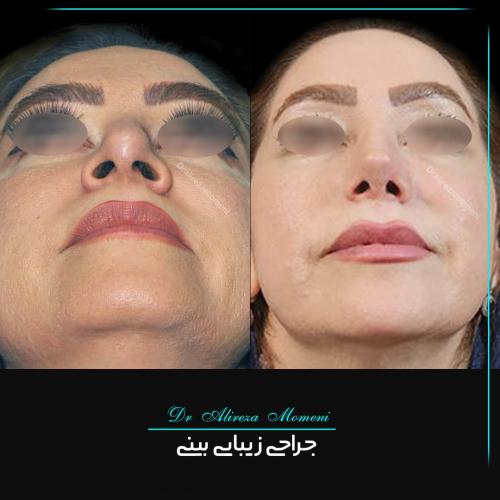 rhinoplasty-455