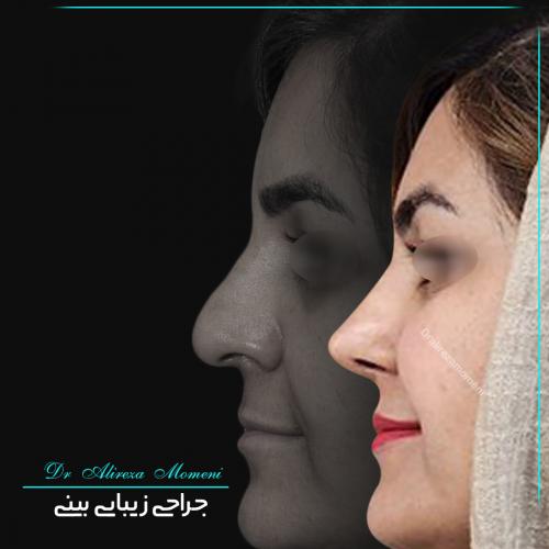 rhinoplasty-456
