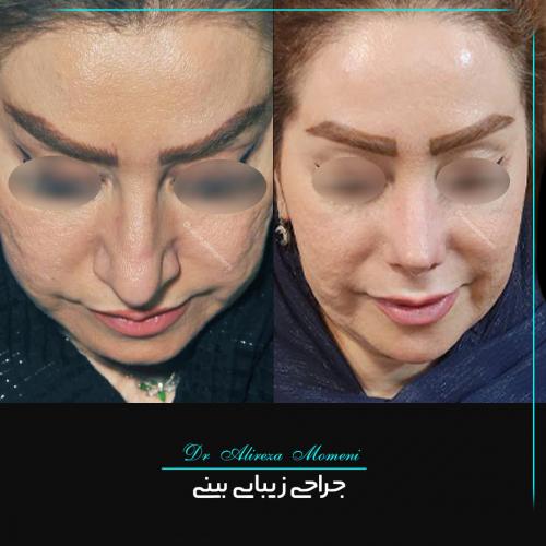 rhinoplasty-457