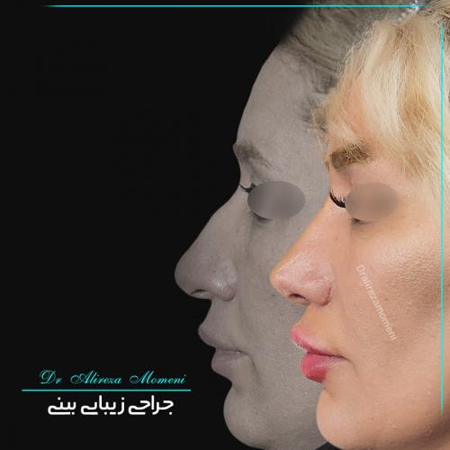 rhinoplasty-458