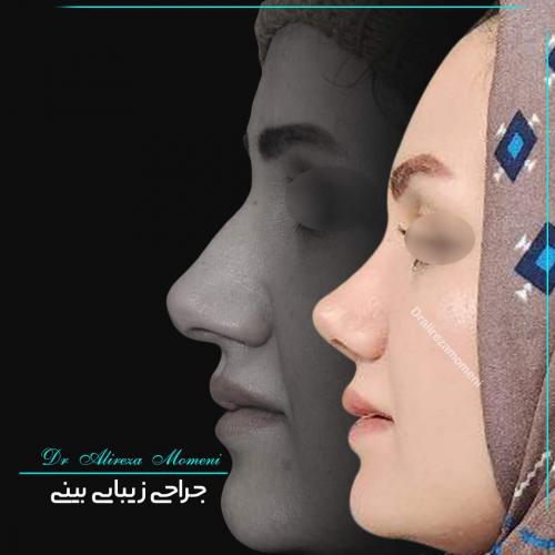 rhinoplasty-459