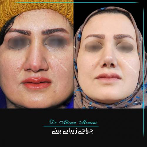 rhinoplasty-460