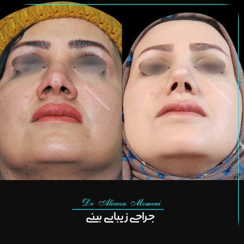 rhinoplasty-461