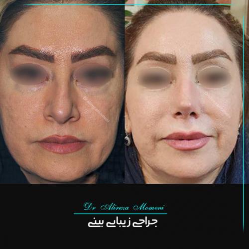 rhinoplasty-462
