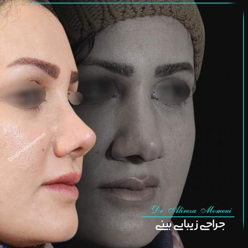 rhinoplasty-463