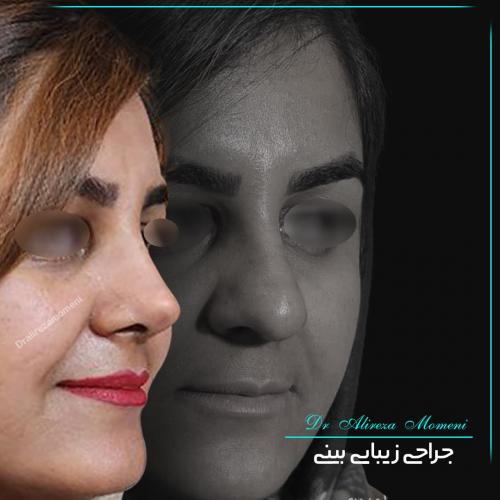 rhinoplasty-464