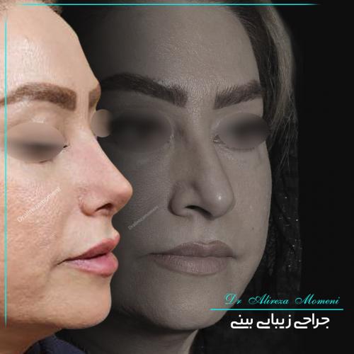 rhinoplasty-465
