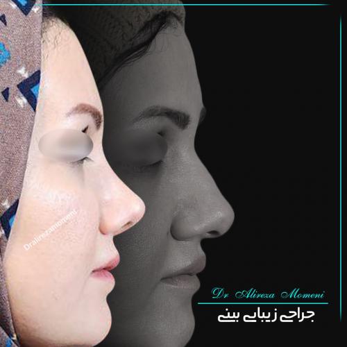 rhinoplasty-466