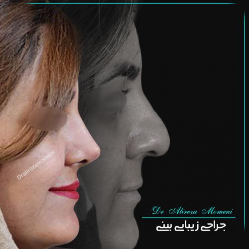 rhinoplasty-467