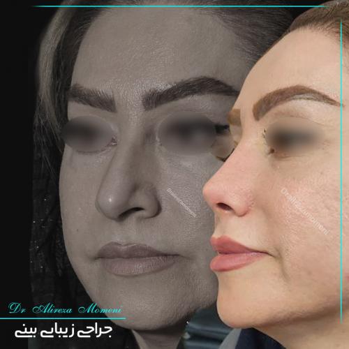 rhinoplasty-468