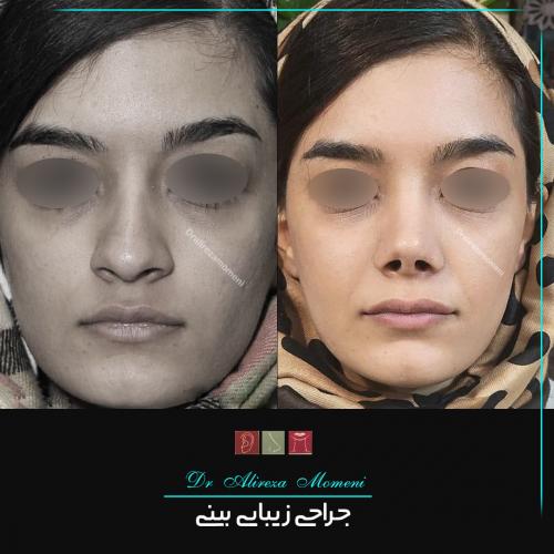 rhinoplasty-469