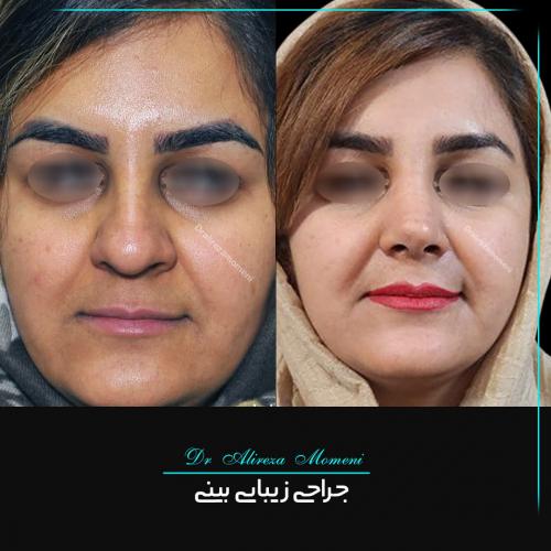 rhinoplasty-470