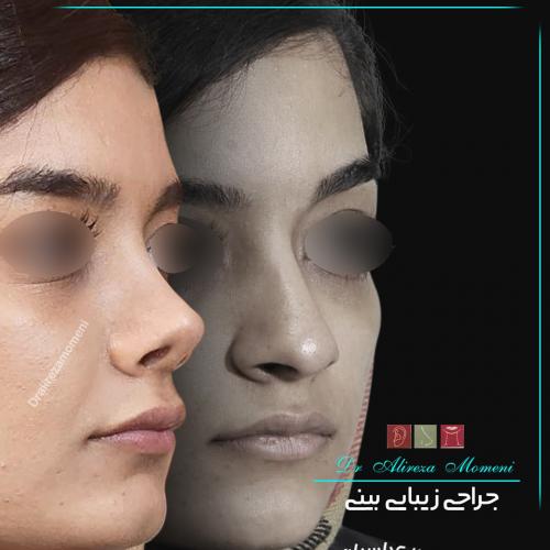 rhinoplasty-471