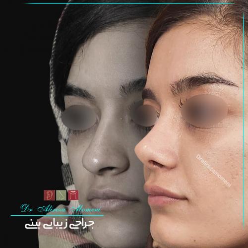rhinoplasty-472