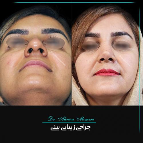 rhinoplasty-474