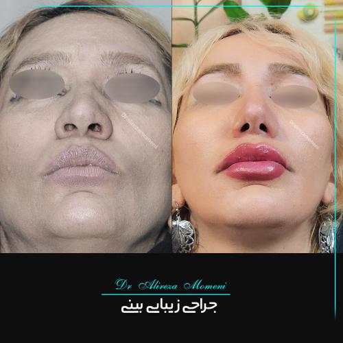 rhinoplasty-475