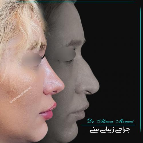 rhinoplasty-476