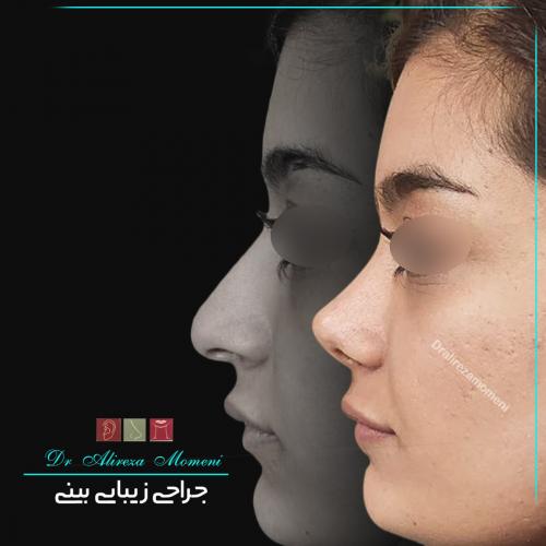 rhinoplasty-477