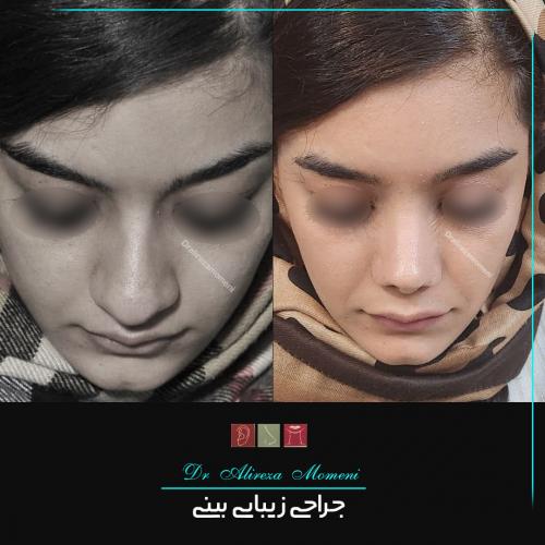 rhinoplasty-478