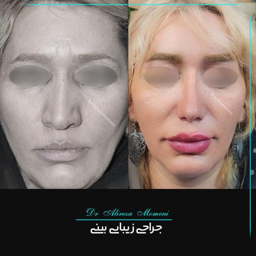 rhinoplasty-479
