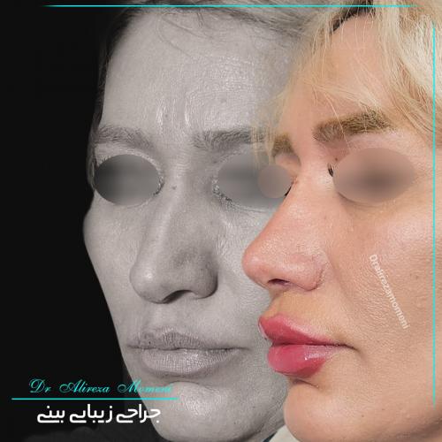 rhinoplasty-480